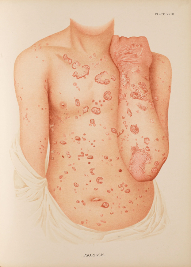 Ein Buchumschlag mit einer Illustration eines Männerkörpers mit roten Flecken, die wahrscheinlich Psoriasis darstellen, neben Text zum Thema.